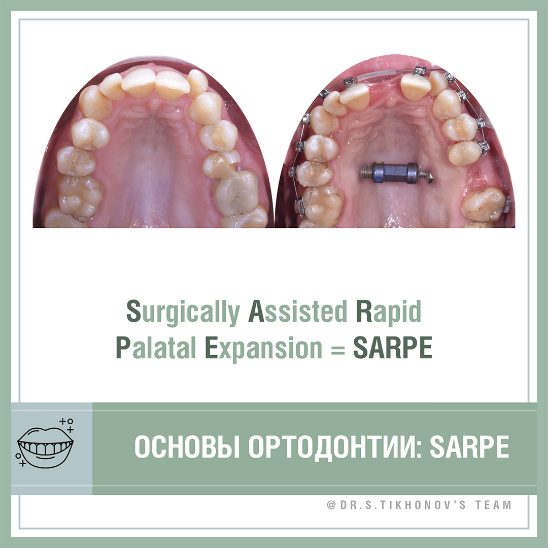 Основы ортодонтии. Surgically Assisted Rapid Palatal Expansion = SARPE