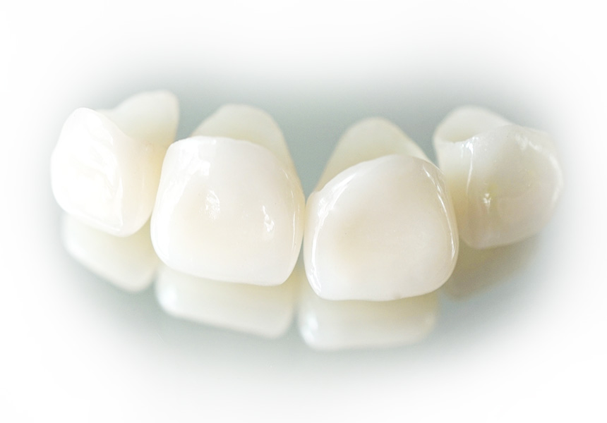 Частичное несъемное протезирование зубов: разновидности, плюсы и минусы, нюансы установки