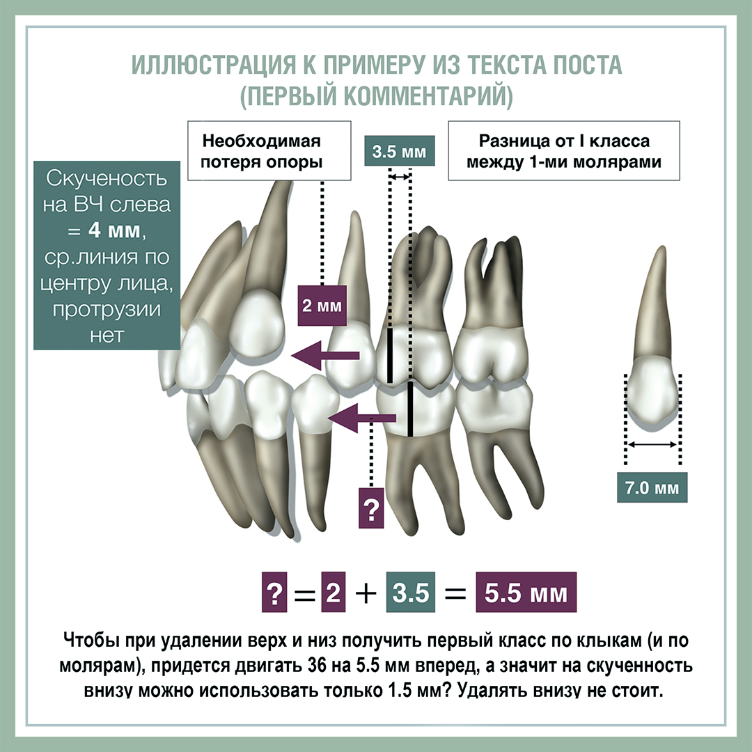 Туманные вопросы ортодонтии: геометрия решений об удалении