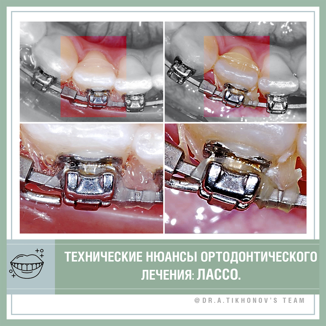 Технические нюансы ортодонтического лечения: Лассо.