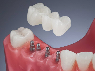 Мини-импланты зубов - это