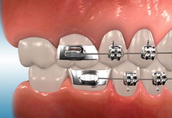 Почему на последние зубы не ставят брекеты