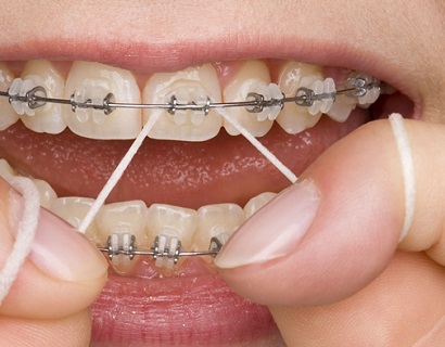 зубная нить - важный компонент ухода за полостью рта при ношении брекетов