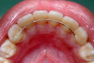 Почему могут болеть зубы после снятия брекетов