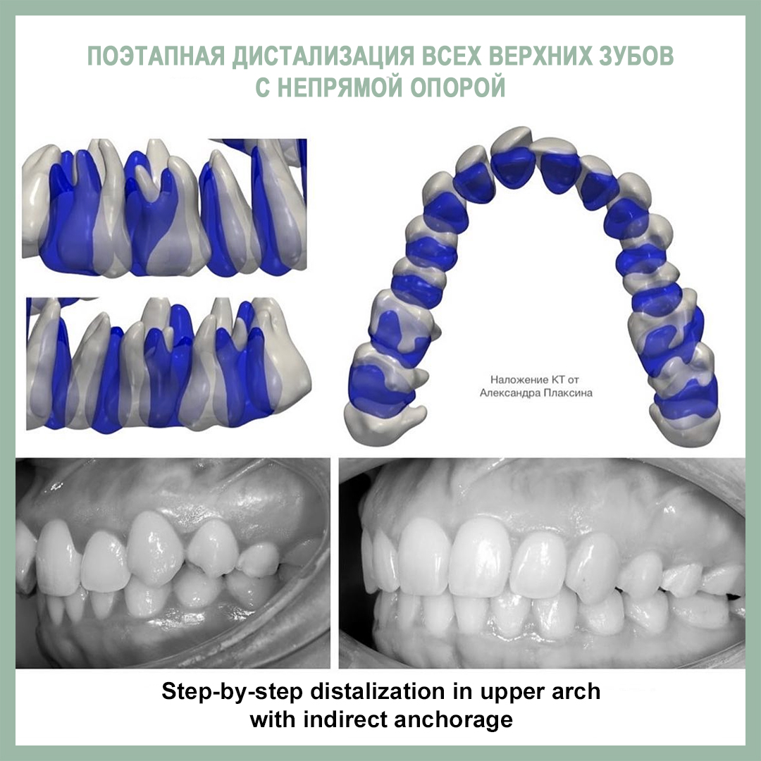Поэтапная дистализация всех верхних зубов с непрямой опорой