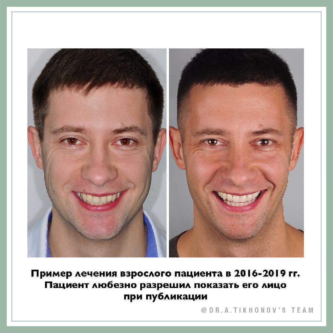 Пример лечения взрослого пациента с 2016-2019 гг. Пациент любезно разрешил показать его лицо при публикации.