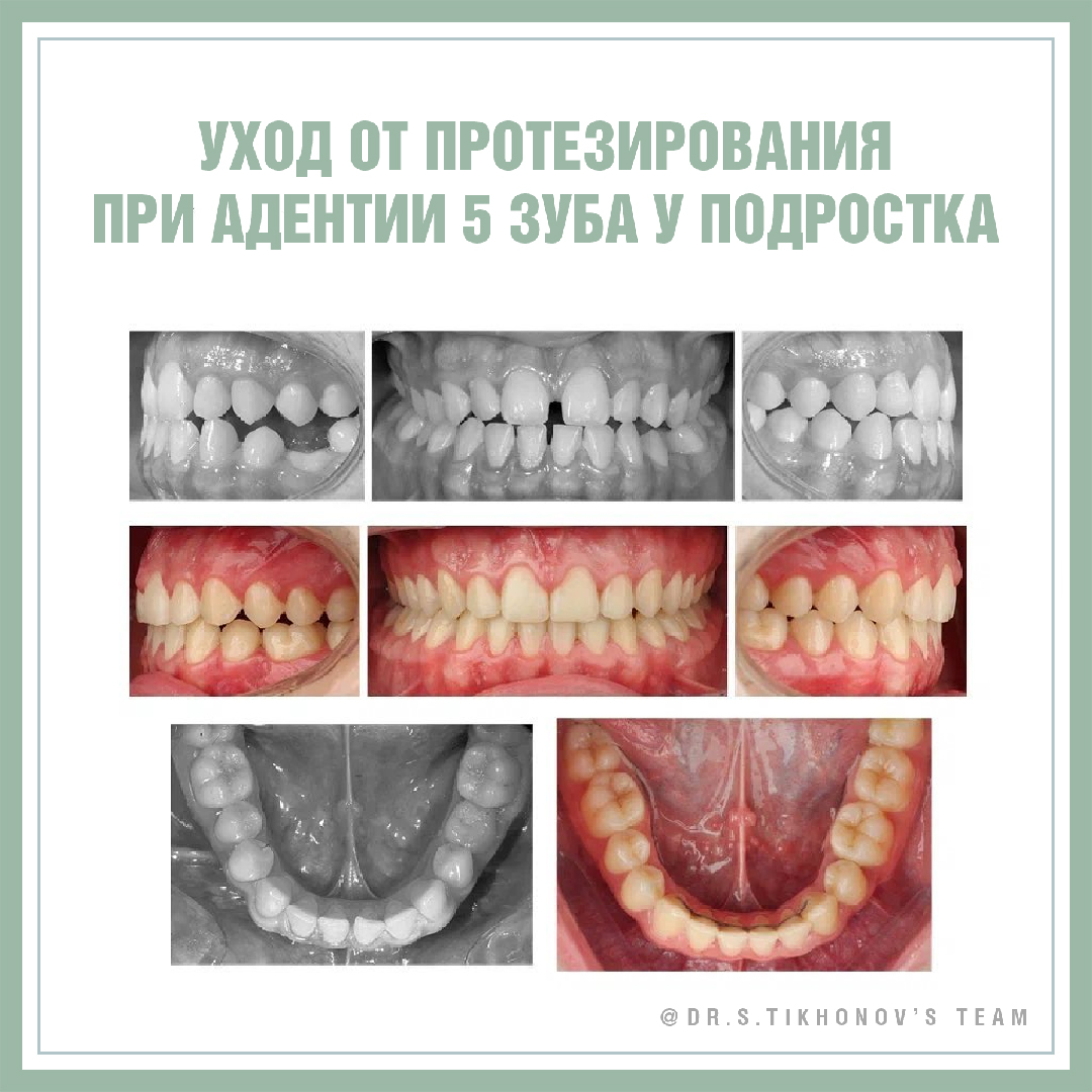Уход от протезирования при адентии 5 зуба у подростка