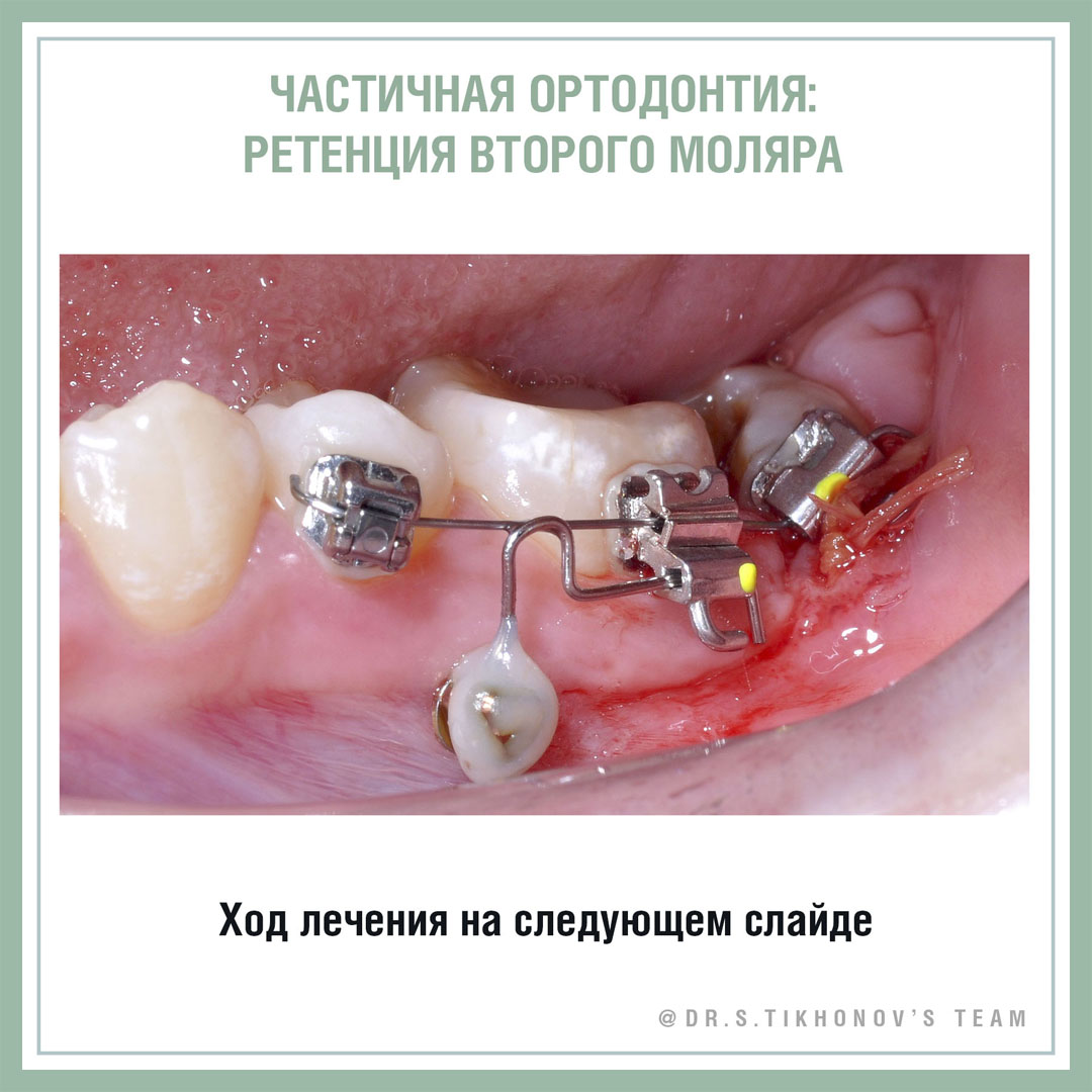 Частичная ортодонтия: ретенция второго моляра