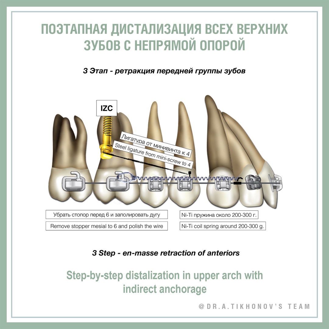 Поэтапная дистализация всех верхних зубов с непрямой опорой. 3 этап - ретракция передней группы зубов