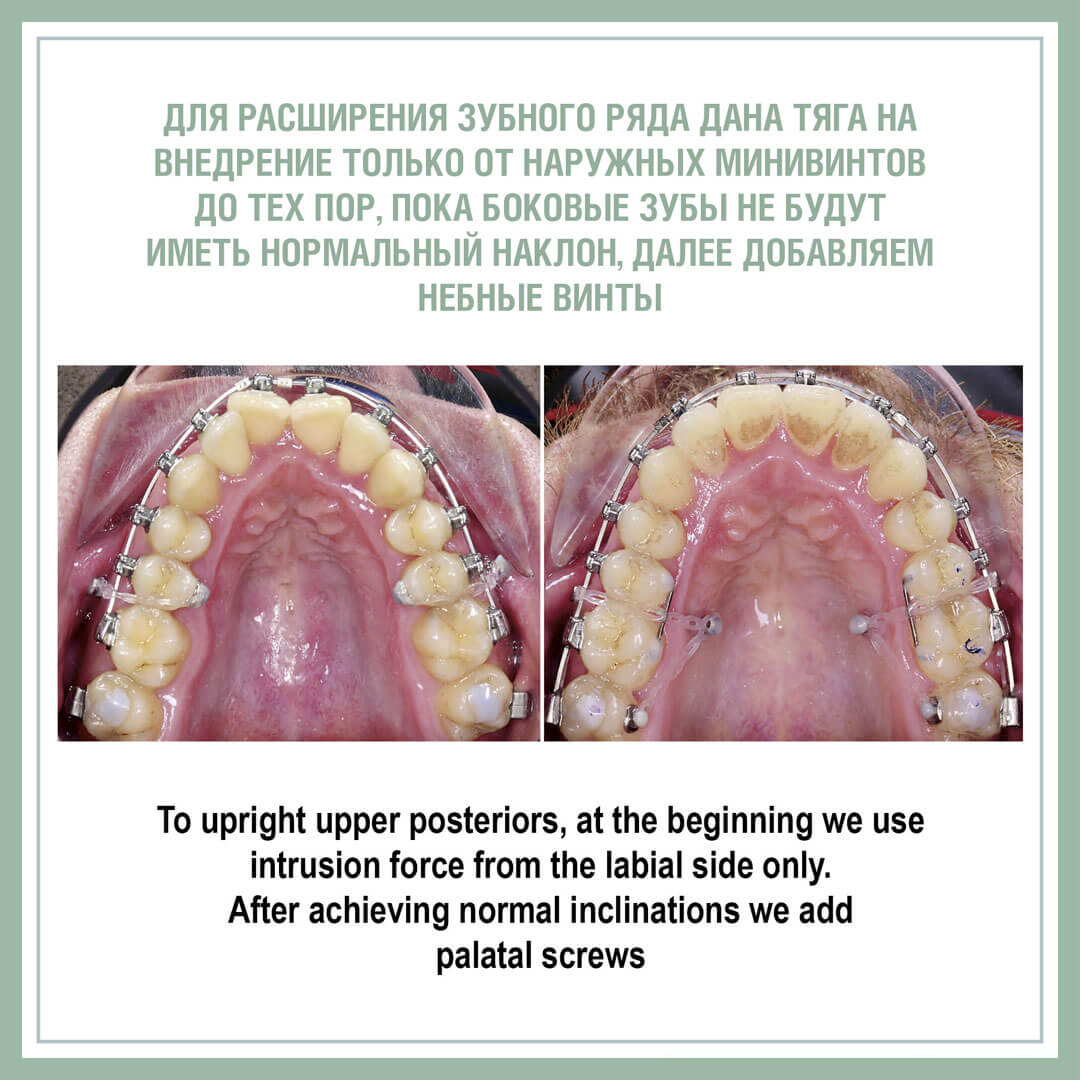 Для расширения зубного ряда дана тяга на внедрение только от наружных минивинтов до тех пор, покабоковые зубы не будут иметь нормальный наклон, далее добавляем небные винты