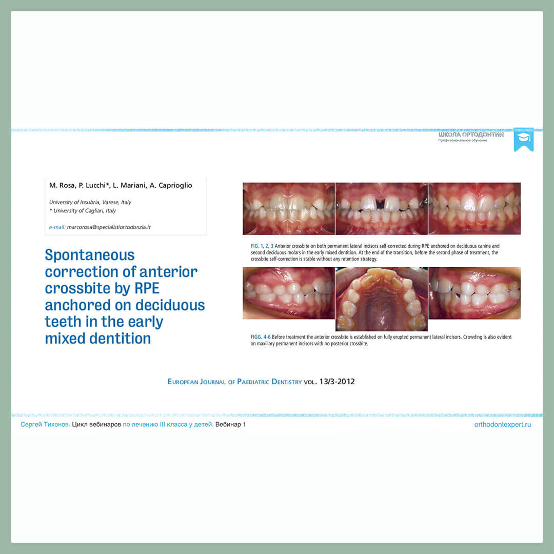 Spontaneous correction of anterior crossbite by RPE anchored on decidious teeth in the early mixed dentition