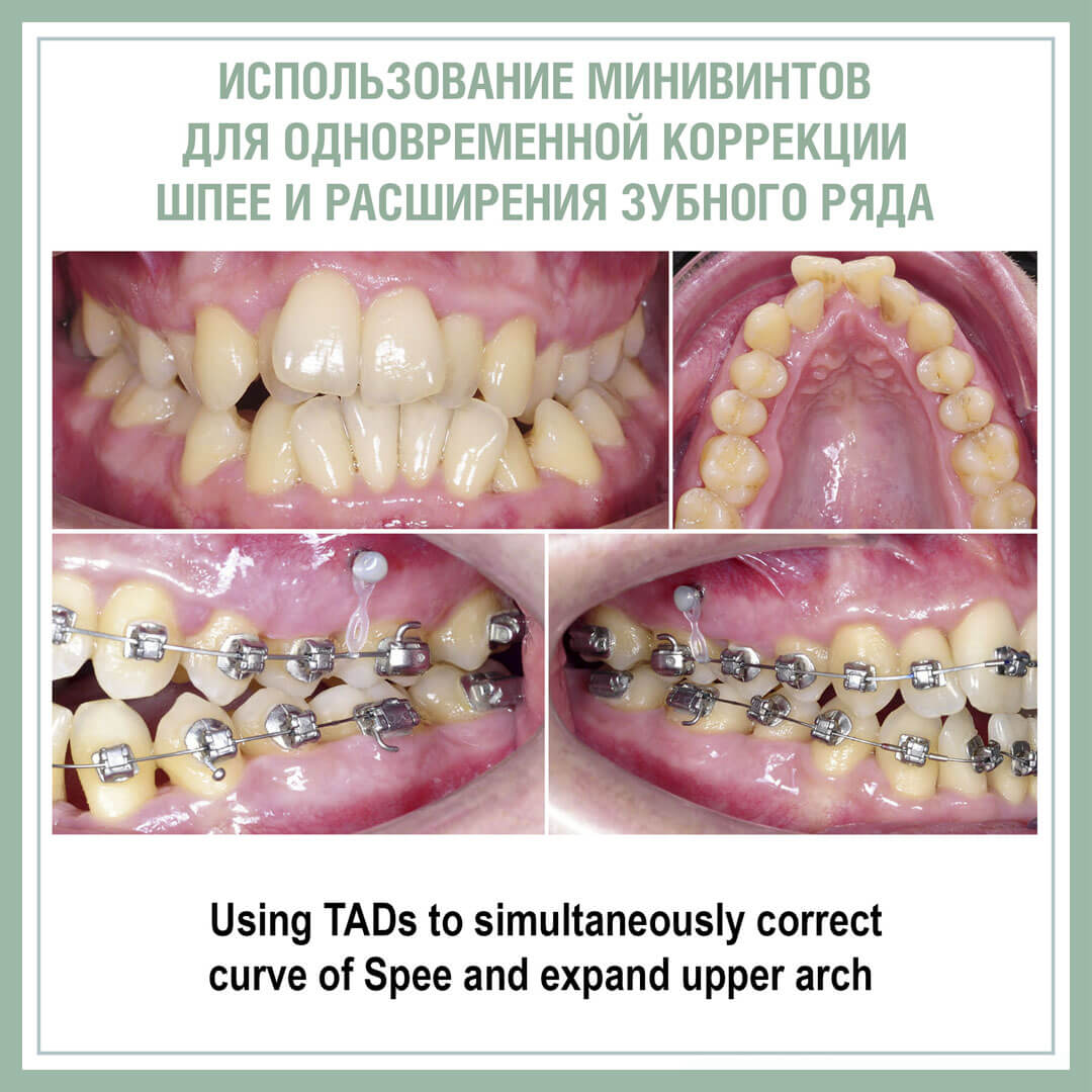 Использование минивинтов для одновременной коррекции Шпее и расширения зубного ряда