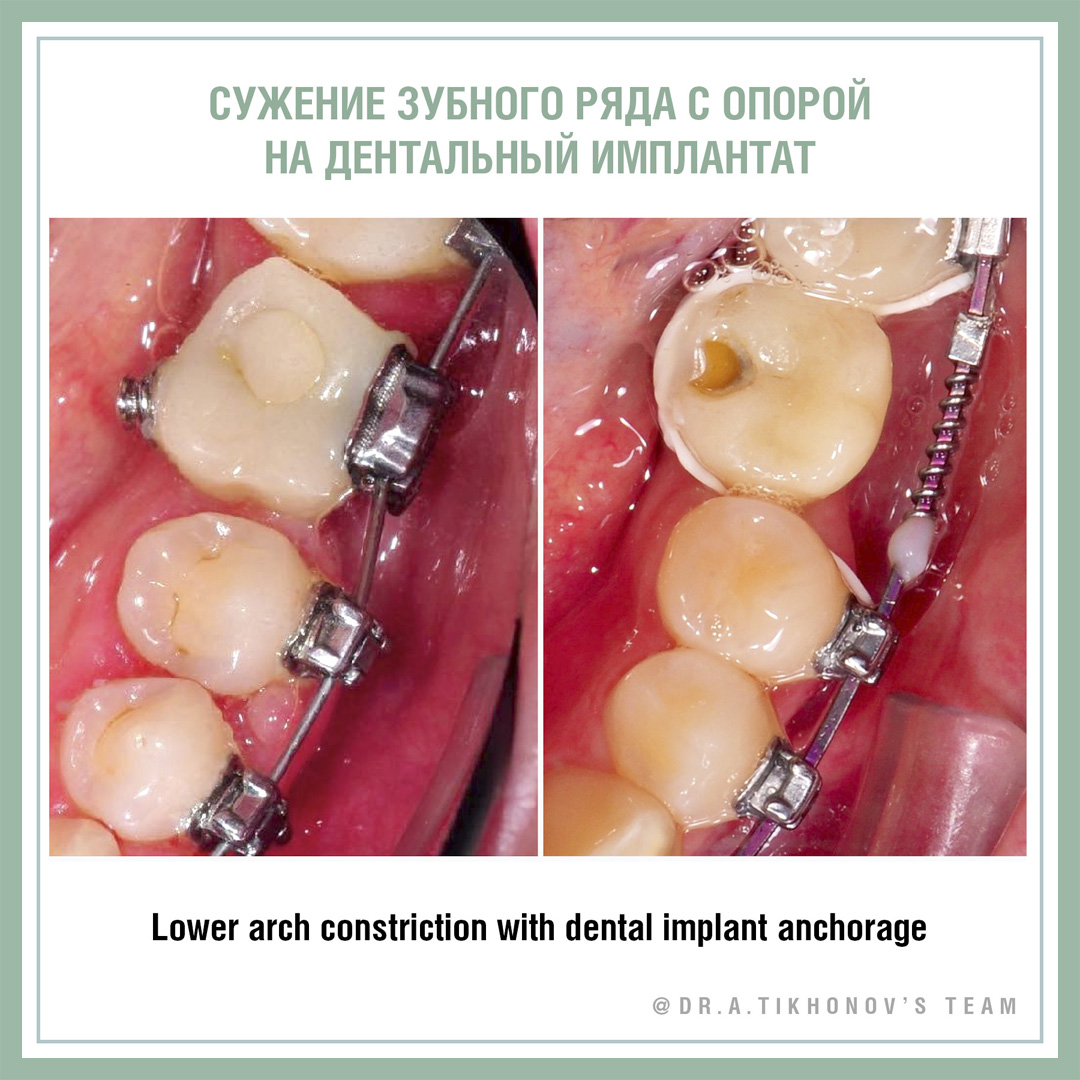 А.В. Тихонов – сужение зубного ряда с опорой на дентальный имплантат