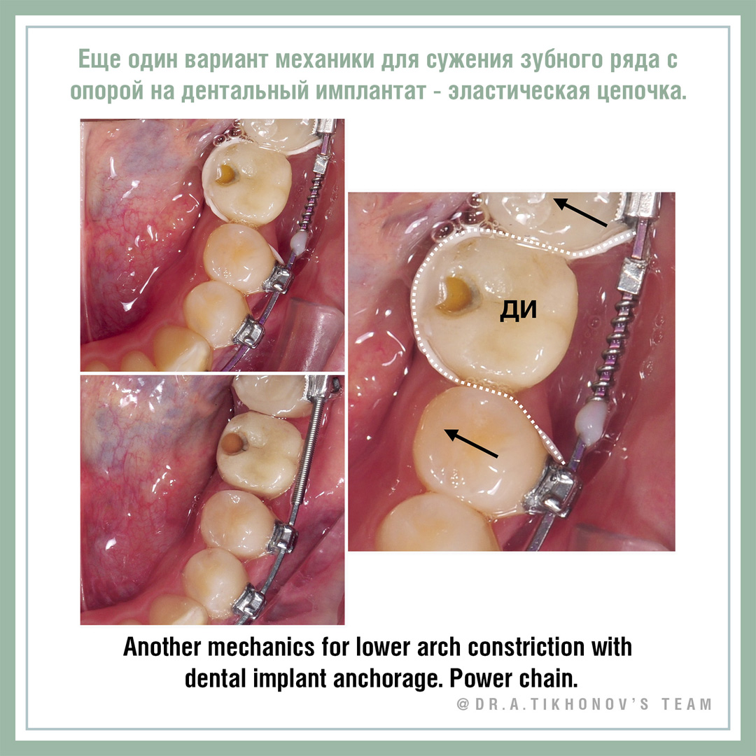 Еще один вариант механики для сужения зубного ряда с опорой на дентальный имплантат - эластическая цепочка