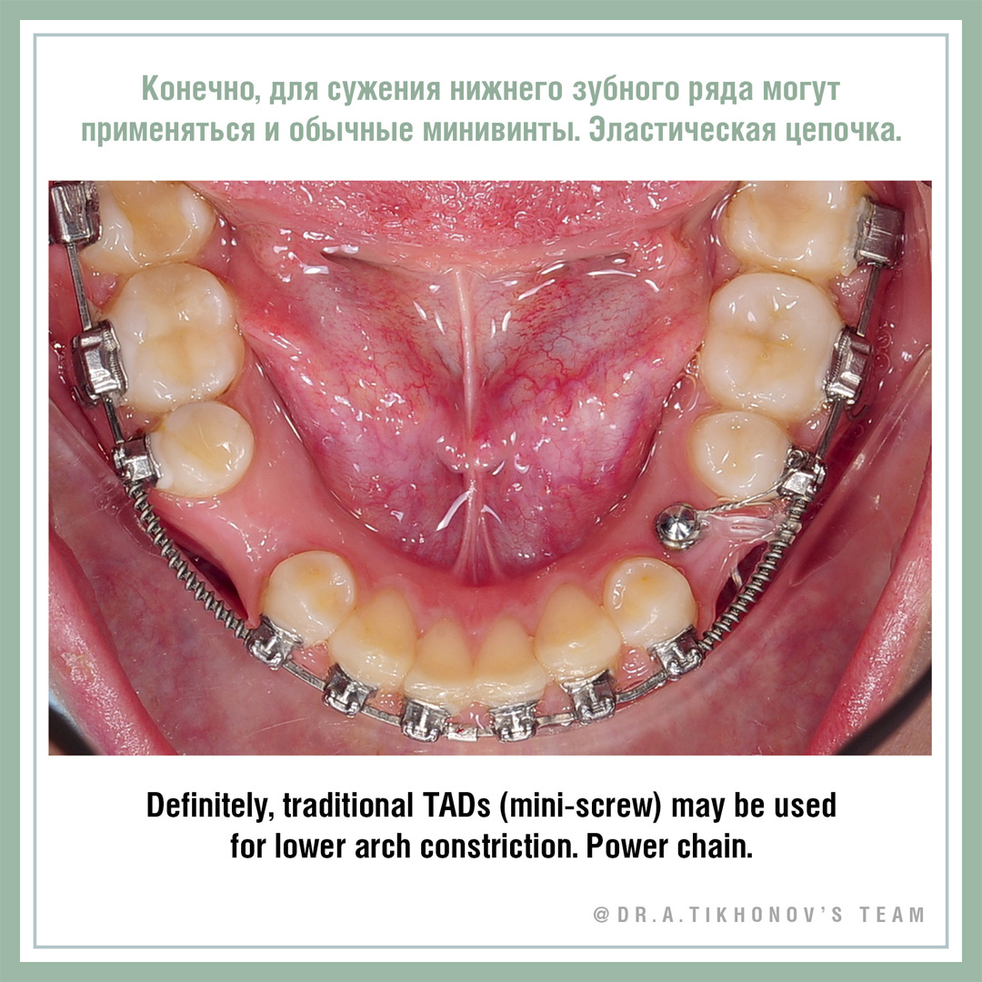 Конечно, для сужения нижнего зубного ряда могут применяться и обычные минивинты. Эластическая цепочка