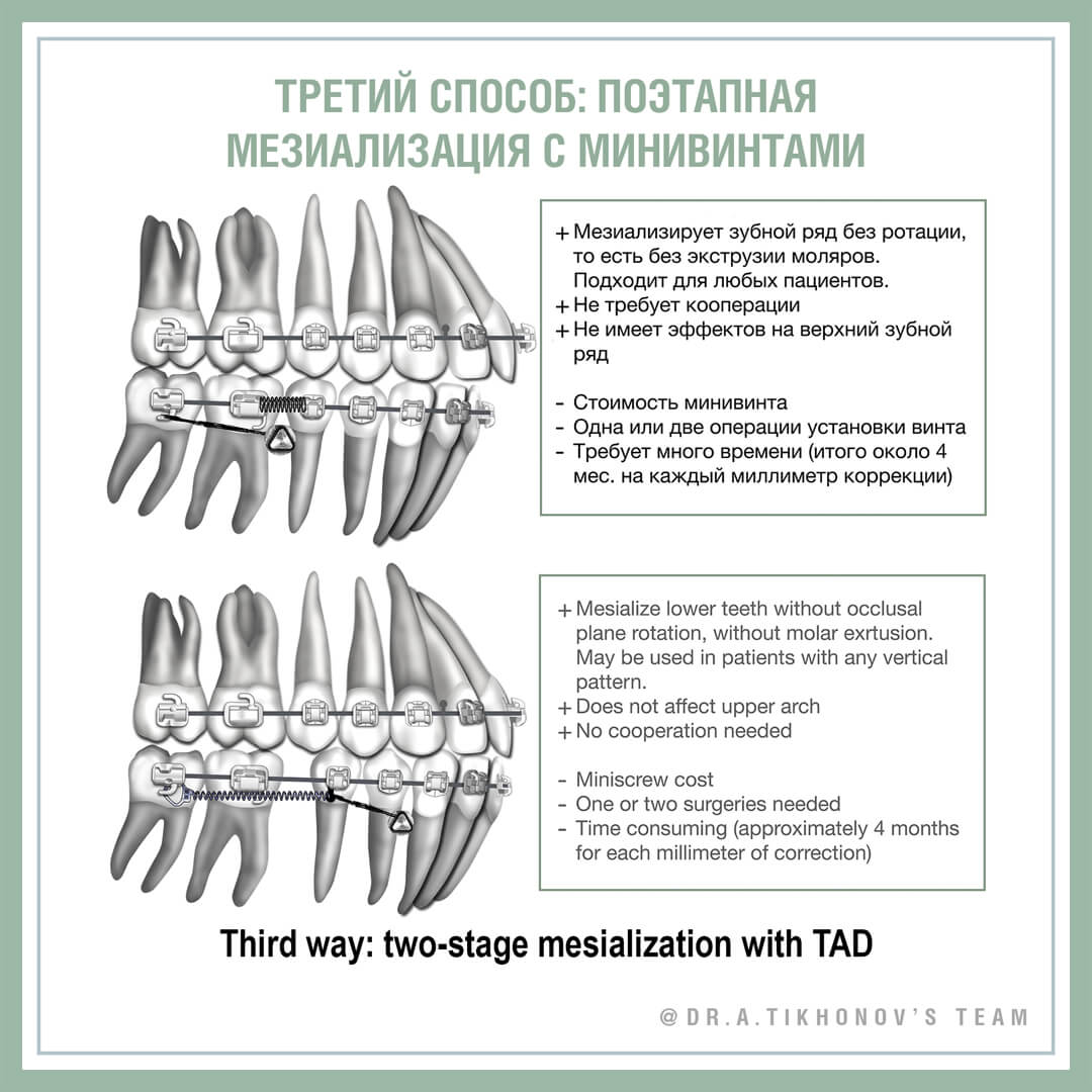 Мезиализация всех нижних зубов при компенсации II класса