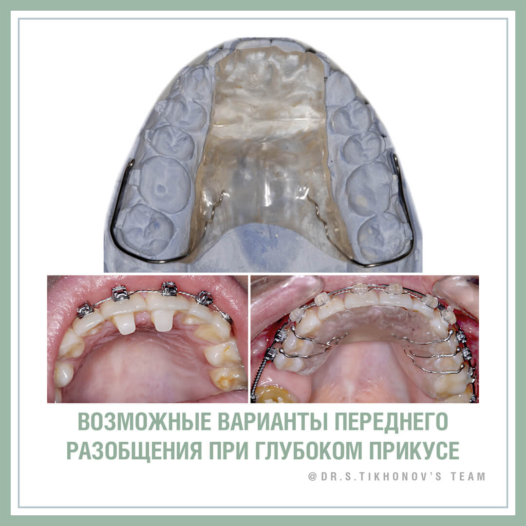 Разобщение зубов ортодонтия