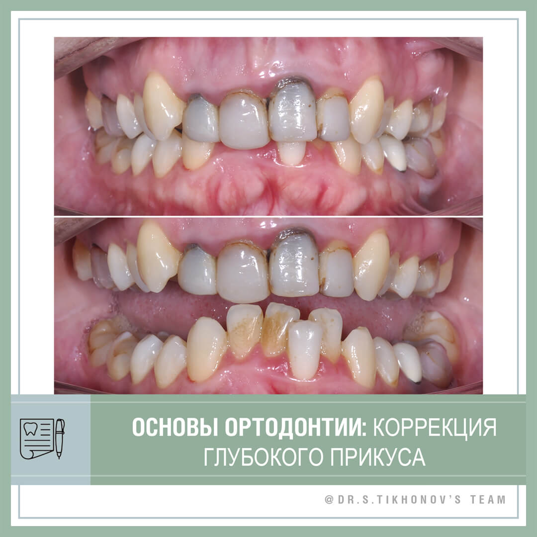 Основы ортодонтии: коррекция глубокого прикуса.