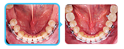 Имплантация 7 зуба