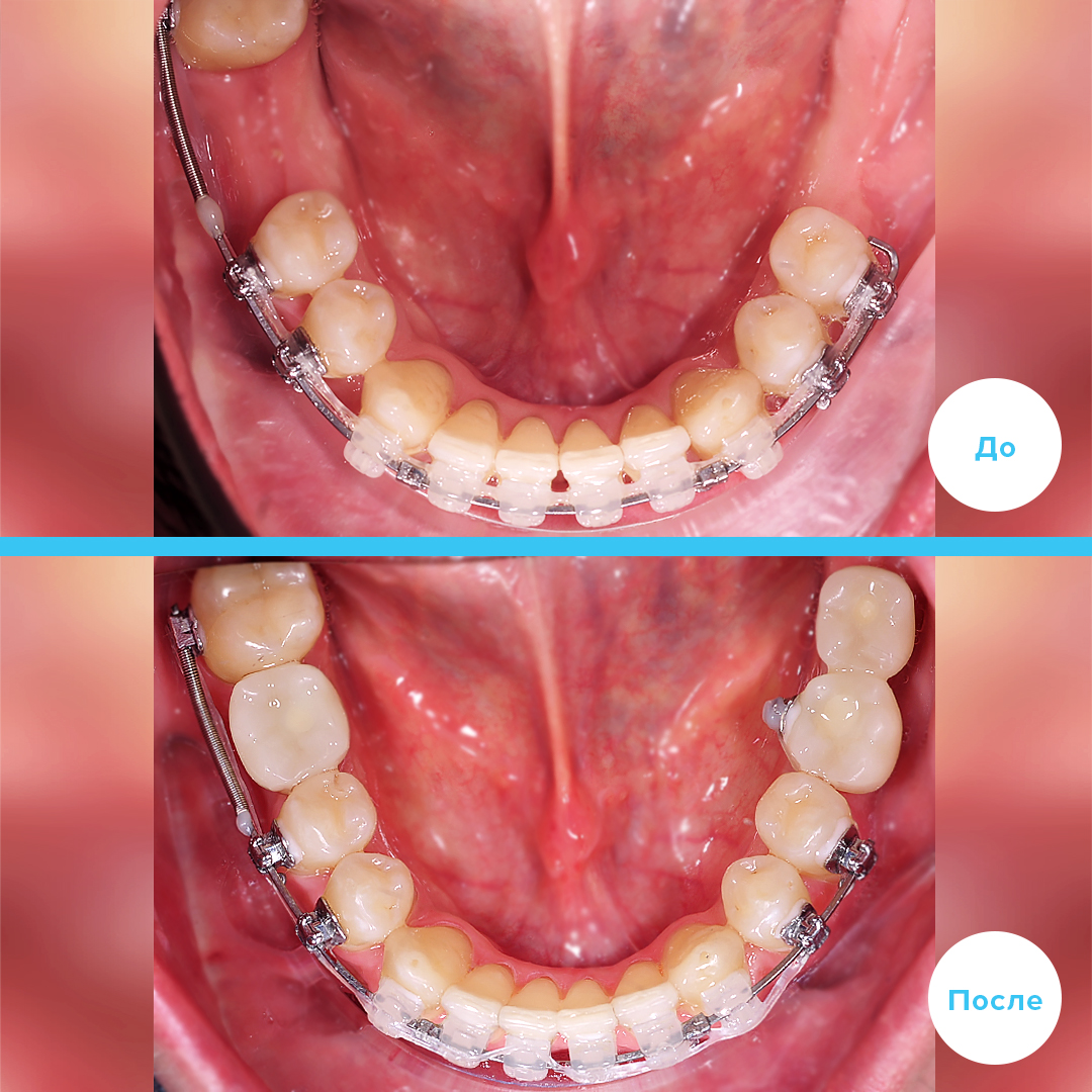 Имплантация 3 зубов 