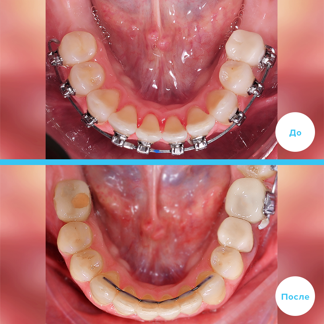 Имплантация двух жевательных 6-х зубов на нижней челюсти