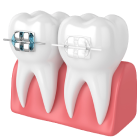 Лечение скученности зубов