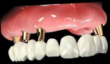 Что такое базальная имплантация зубов?