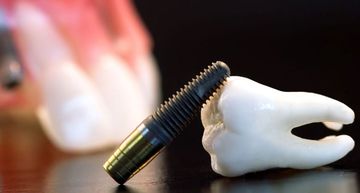 Керамические импланты зубов