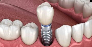 Титановые импланты для зубов