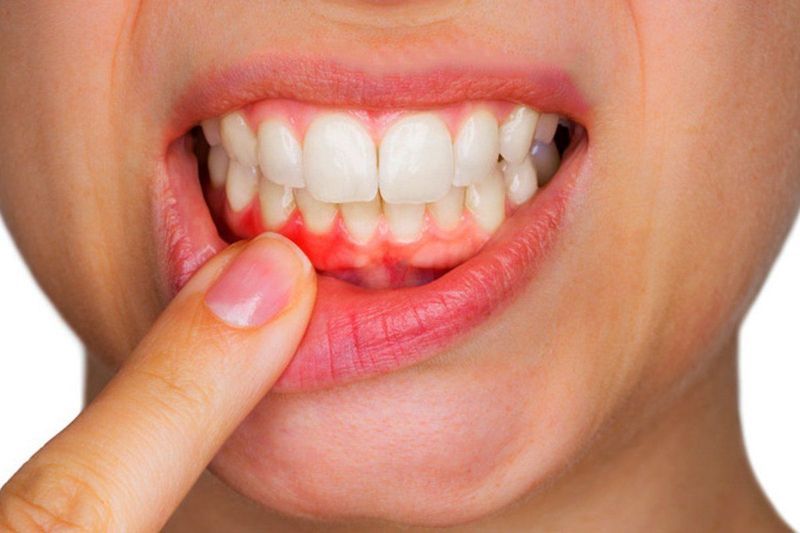 Съемное и несъемное протезирование зубов при пародонтозе: варианты