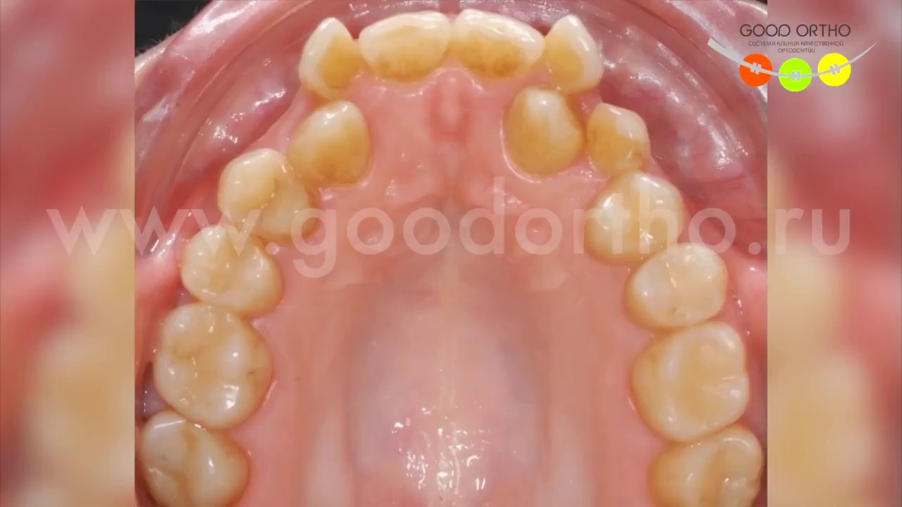 Постановка в зубной ряд клыков с помощью внутренних брекетов Incognito.