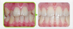 Неровное положение передних зубов (резцов), в том числе положение вторых зубов внутрь (небное положение)