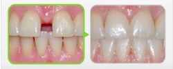 Промежутки между передними зубами (диастема, тремы)