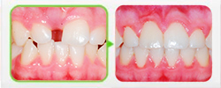 Ретенция зубов (непрорезывание одного или нескольких зубов)​