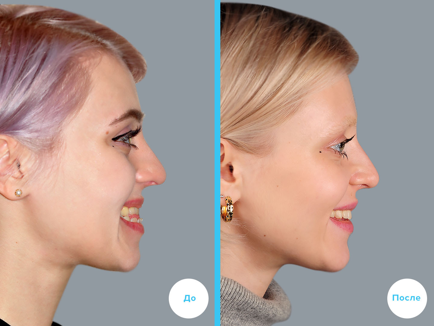 Результаты лечения с лицом