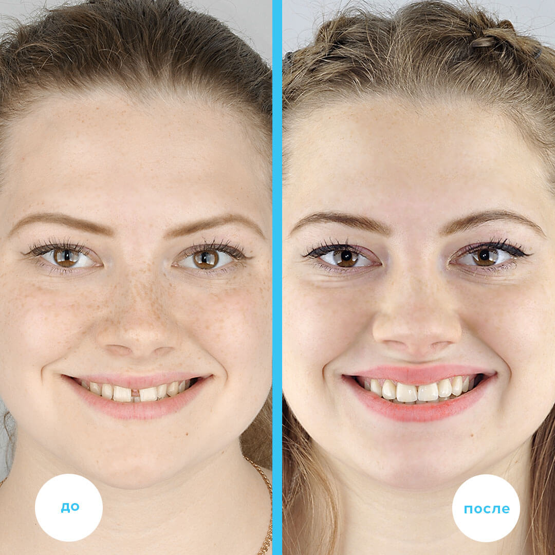 Результаты лечения с лицом