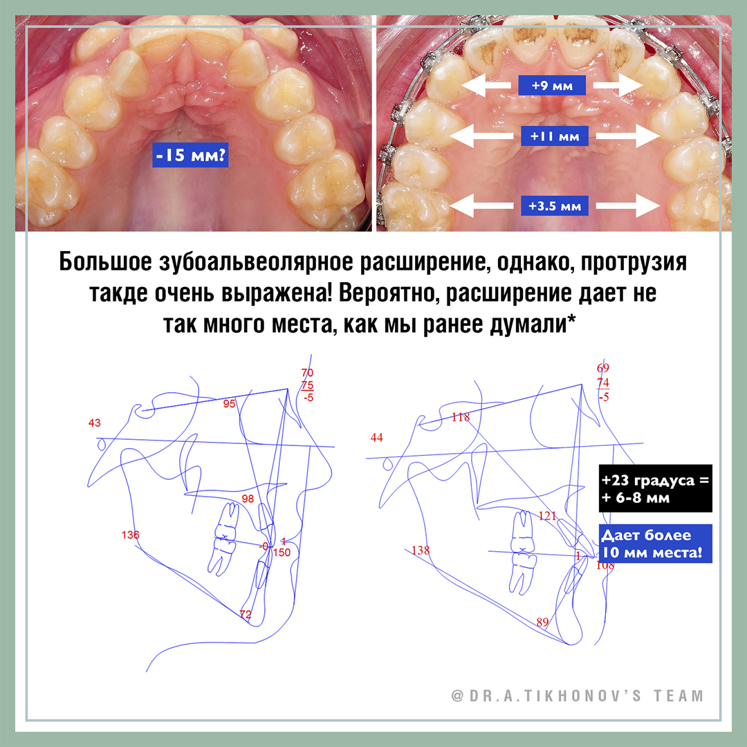 Большое зубоальвеолярное расширение