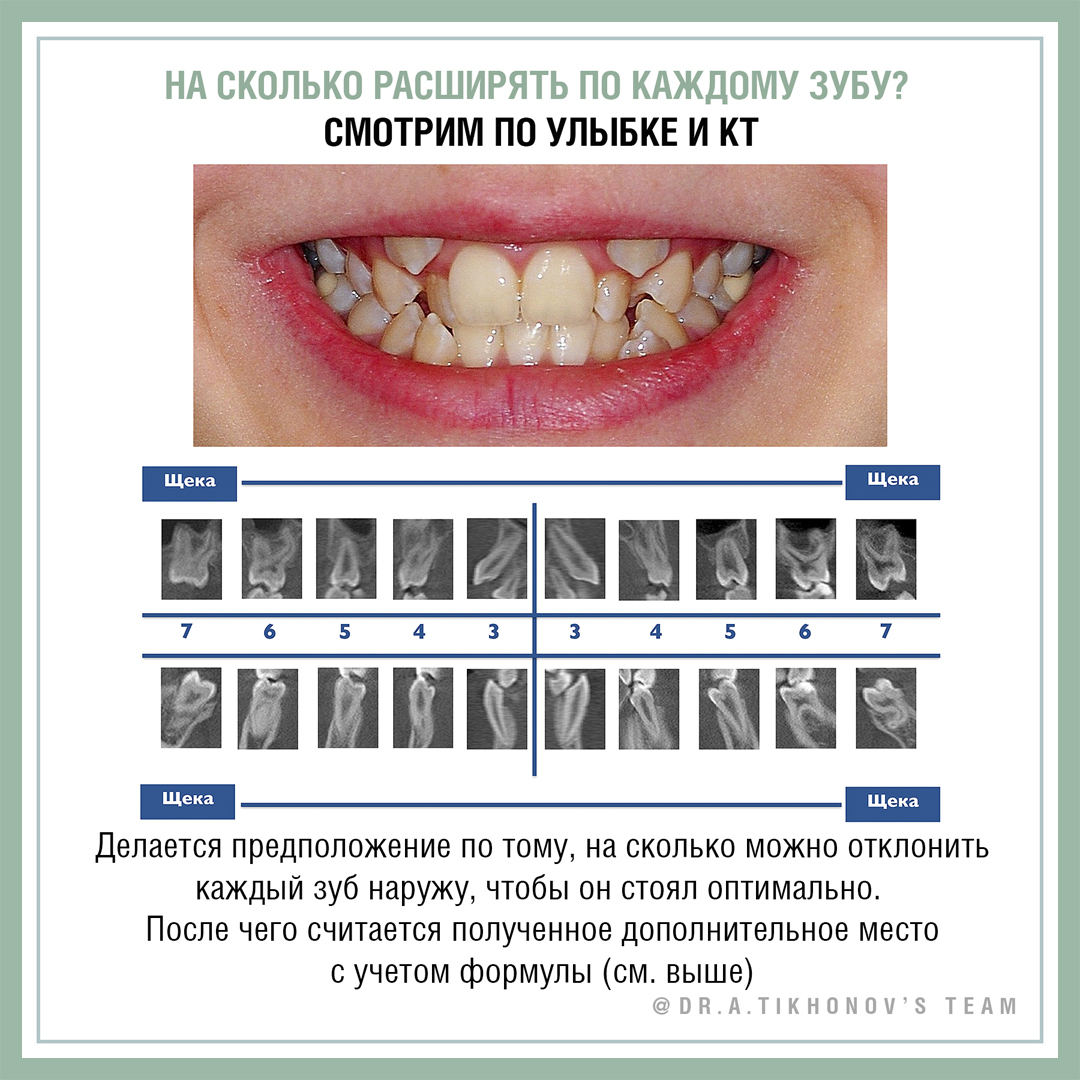На сколько расширять по каждому зубу