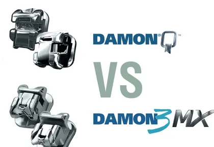 Чем отличаются брекеты Damon Q и брекеты Damon 3MX?