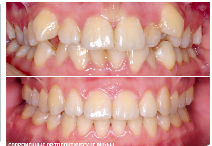 Удаление – это ужасно!