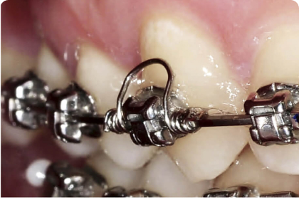 Туманные вопросы ортодонтии. Работают ли торковые пружины?