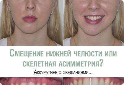 «Неровное лицо» или скелетная асимметрия – аккуратнее с обещаниями