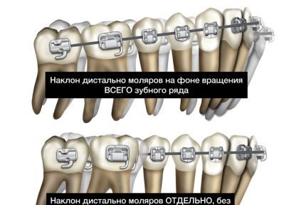 Два типа наклонной дистализации моляров