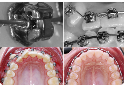 Использование лигатур с самолигирующими брекетами.