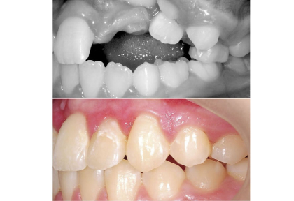 Ретенция и частичная транспозиция. 1 этап лечения.