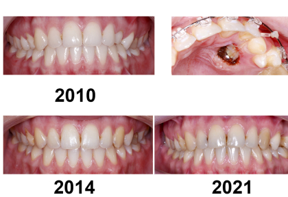 Небная ретенция клыка через 7 лет после лечения
