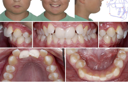 Лучшие брекеты для детей: какие выбрать?