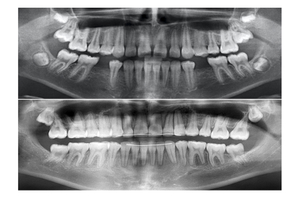 Закрытие пространств при адентии нижних 5?