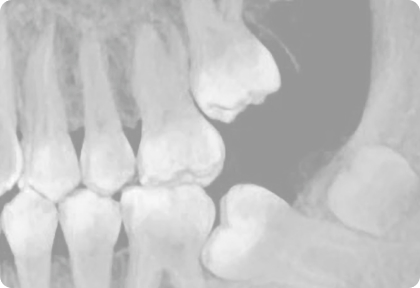 Частичная ортодонтия: ретенция второго моляра