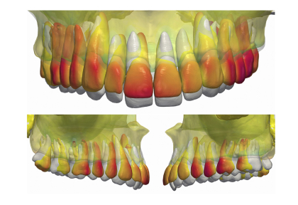 А.В. Тихонов – внедрение верхнего зубного ряда